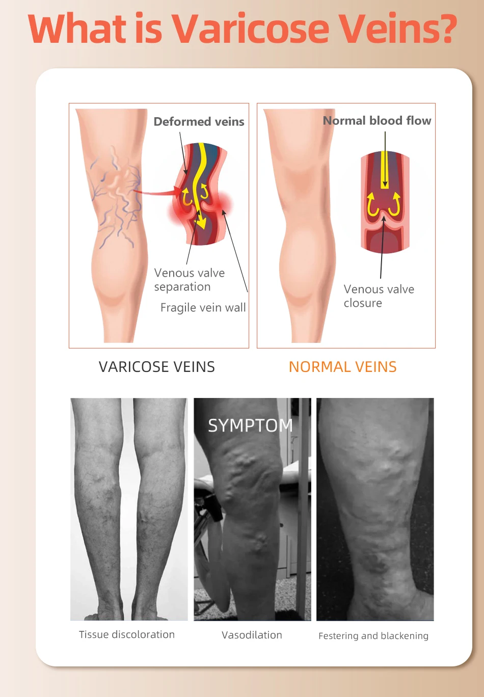 30-40 MmHg Over Knee Closed To - đánh giá và giá Compression Sock Medical